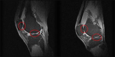 A marker-less human motion analysis system for motion-based biomarker identification and quantification in knee disorders